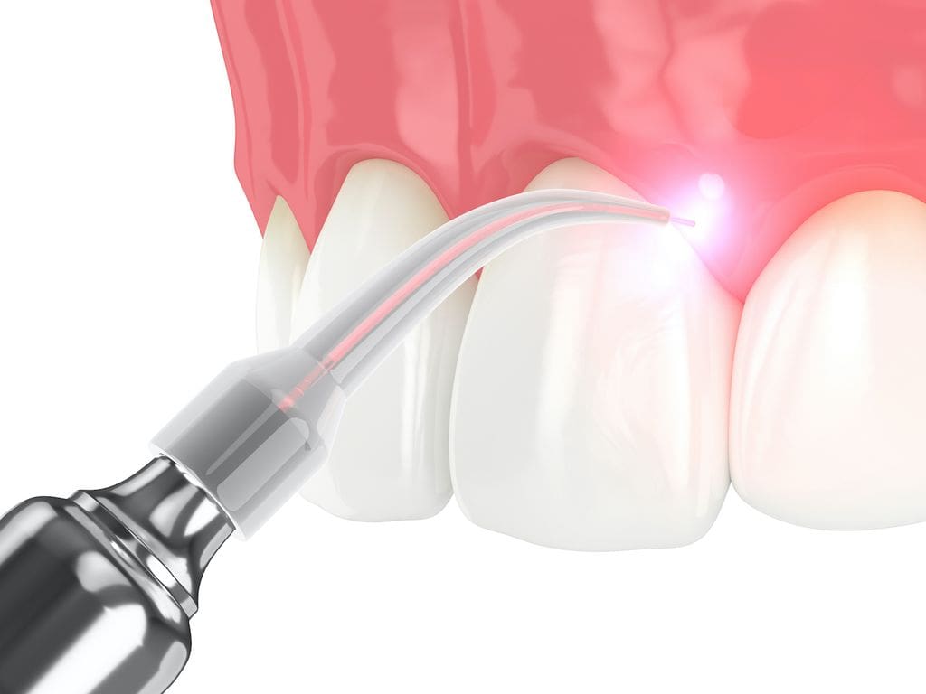 Laser Dentistry in Skokie and Chicago, IL