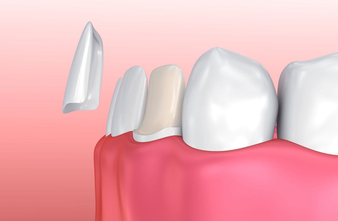 Porcelain Veneers in Skokie and Chicago, IL