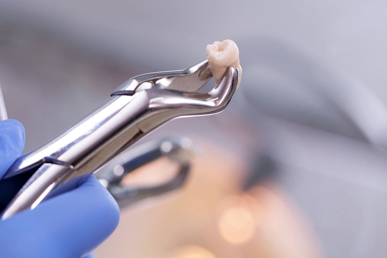 Tooth Extraction in Chicago and Skokie, IL