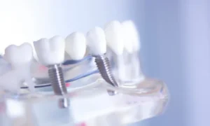 How Dental Bridges Can Restore Your Smile in Skokie, IL